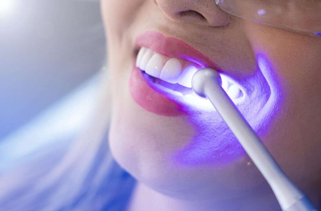 blanqueamiento dental