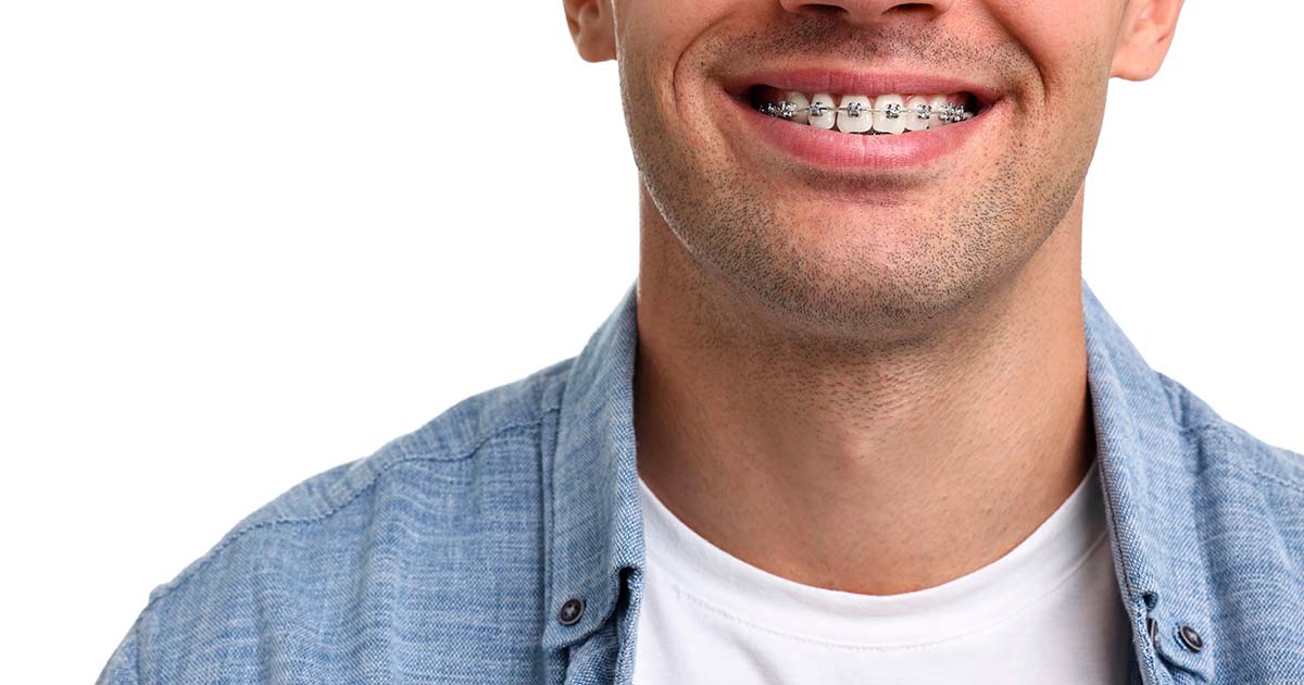 Ortodoncia en adultos con alineadores transparentes en Clínica Dental Primer Molí, Castellón